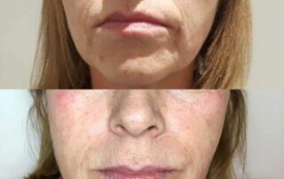 Lip enhancement treatment Derry/Londonderry