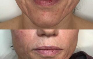 Lip injections Northern Ireland