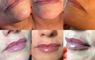 Lip fillers Northern Ireland