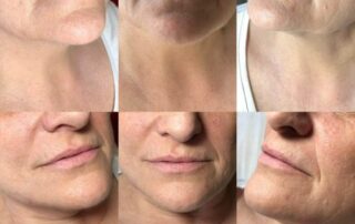 Lip fillers Lip injections Derry
