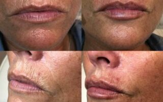 Natural lip fillers derry/londonderry