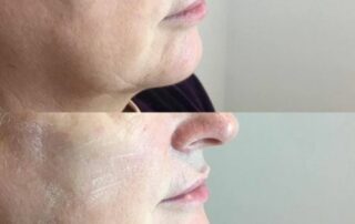 Jaw defining dermal fillers