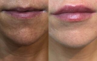 Lip injections Derry/Londonderry