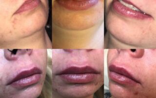 lip aesthetic treatments Londonderry