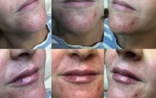 Natural lip enhancement derry