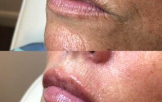 Precision outline lip filler