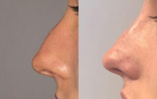 Non surgical nose filler dermal filler