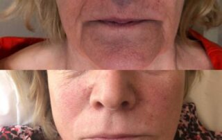 smooth smile lines treatment