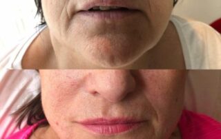 Fineline clinical dermal fillers for lips