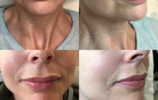 minimal bruising, professional lip fillers