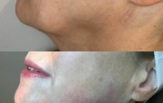 Sculpting jaw treatment