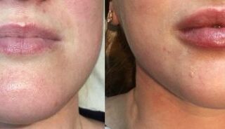 Minimal bruising lip fillers