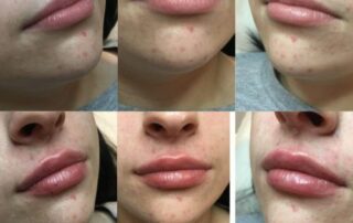 natural lip fillers northern Ireland