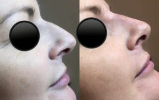 Nose Filler Non surgical nose job
